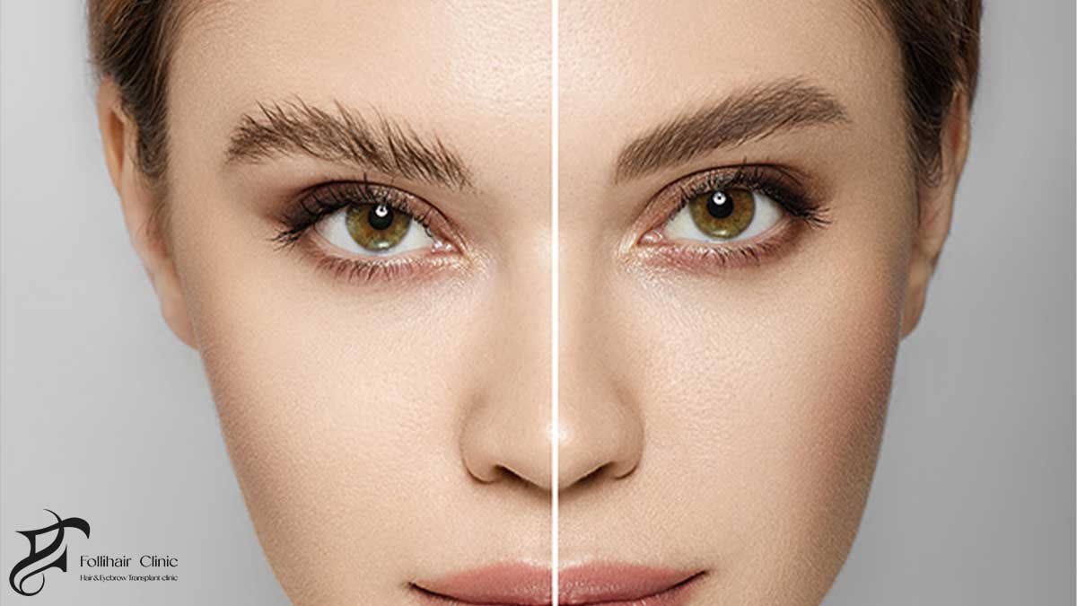 Eyebrow Transplant Cost