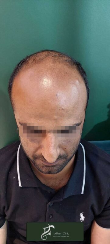 Hair-transplant-5-1