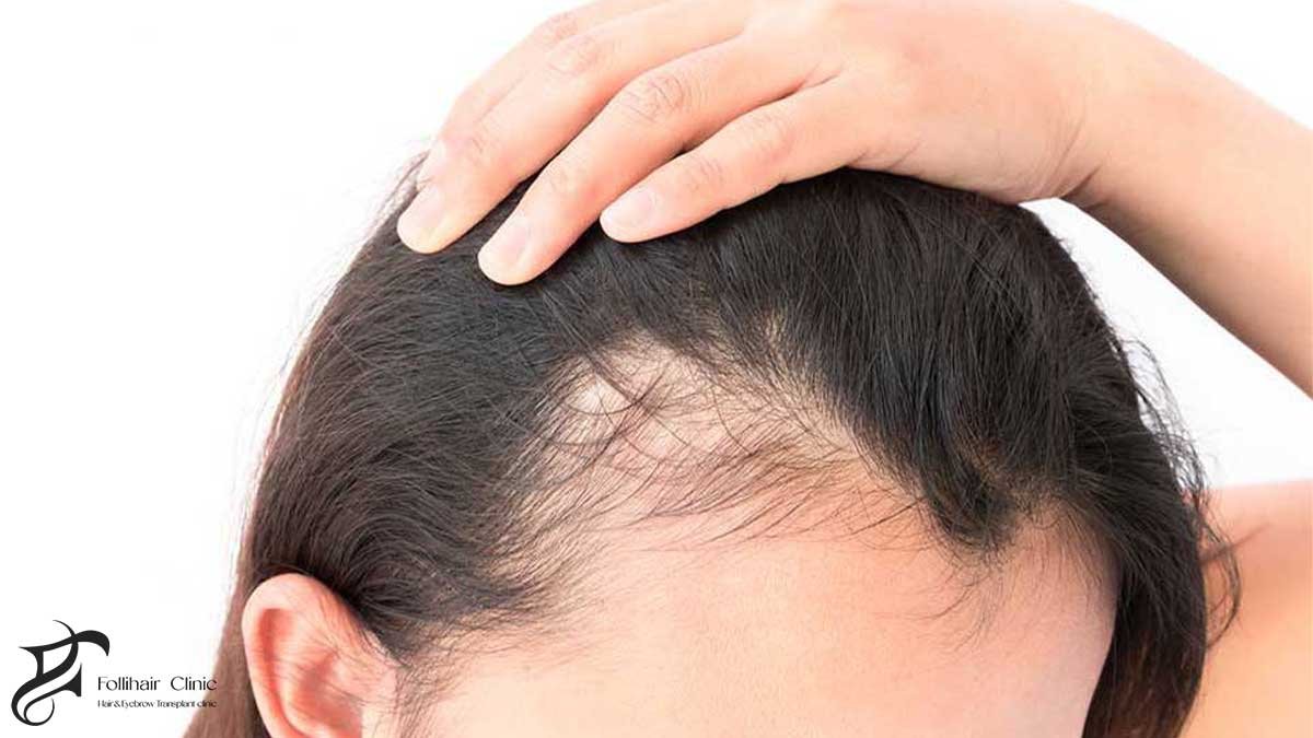 hair loss reasons