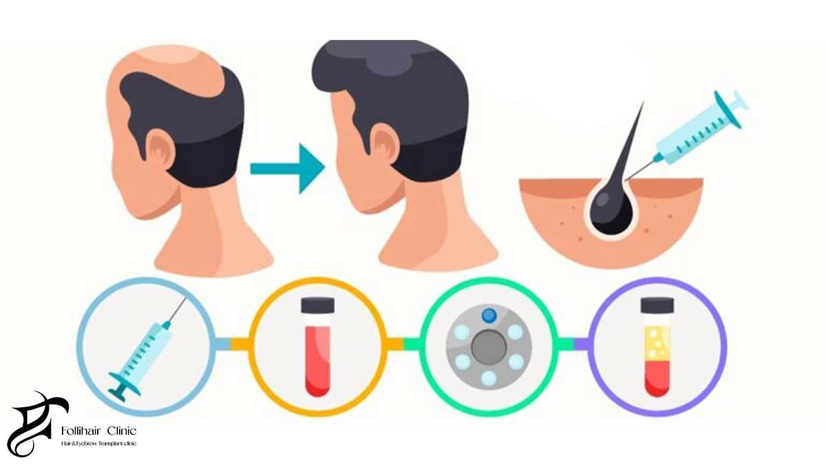 Capillary Treatment vs Hair Transplant