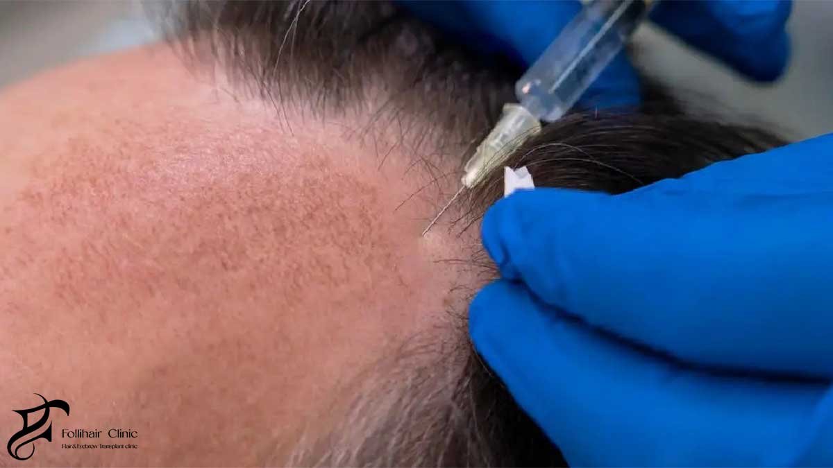 Hair Transplant
