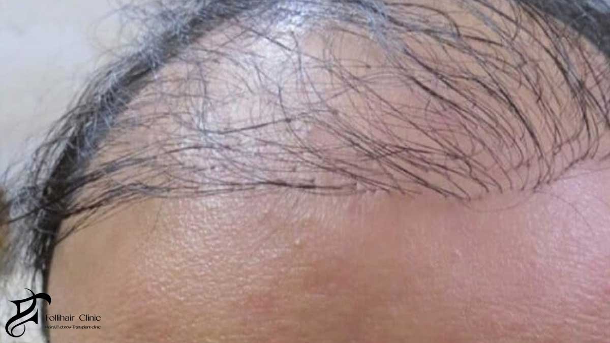 Post Hair Transplant Mistakes