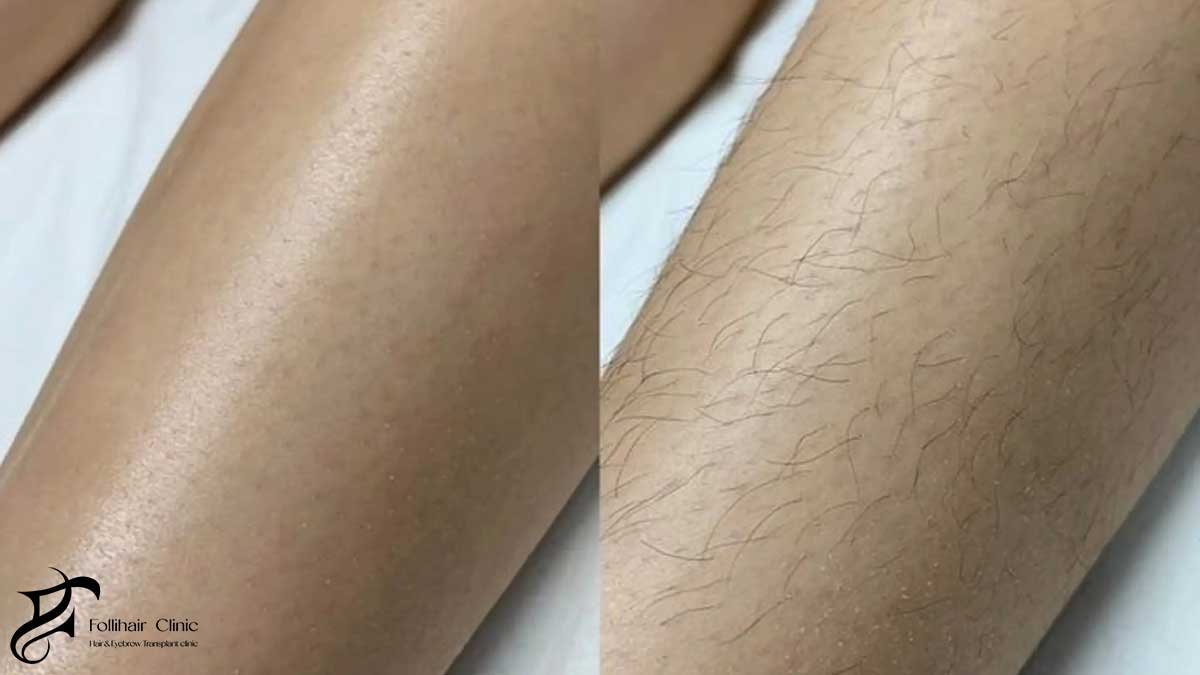 How Hair Growth Cycles Affect Treatment Scheduling