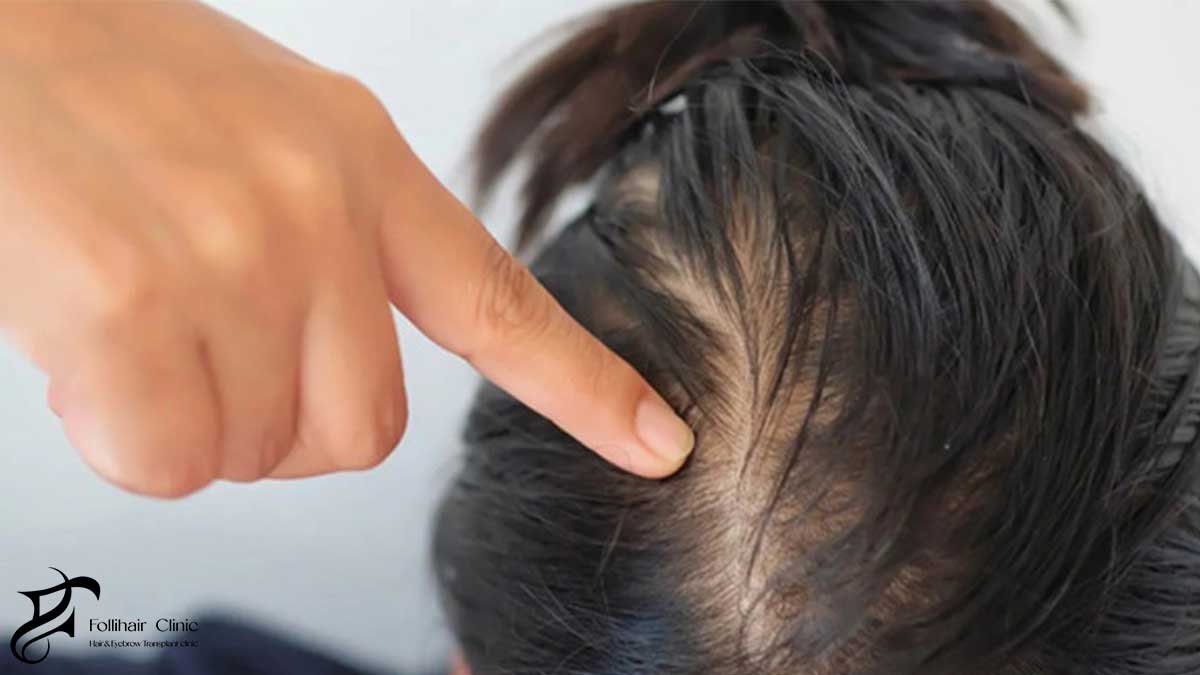 non-genetic hair loss diagnosis