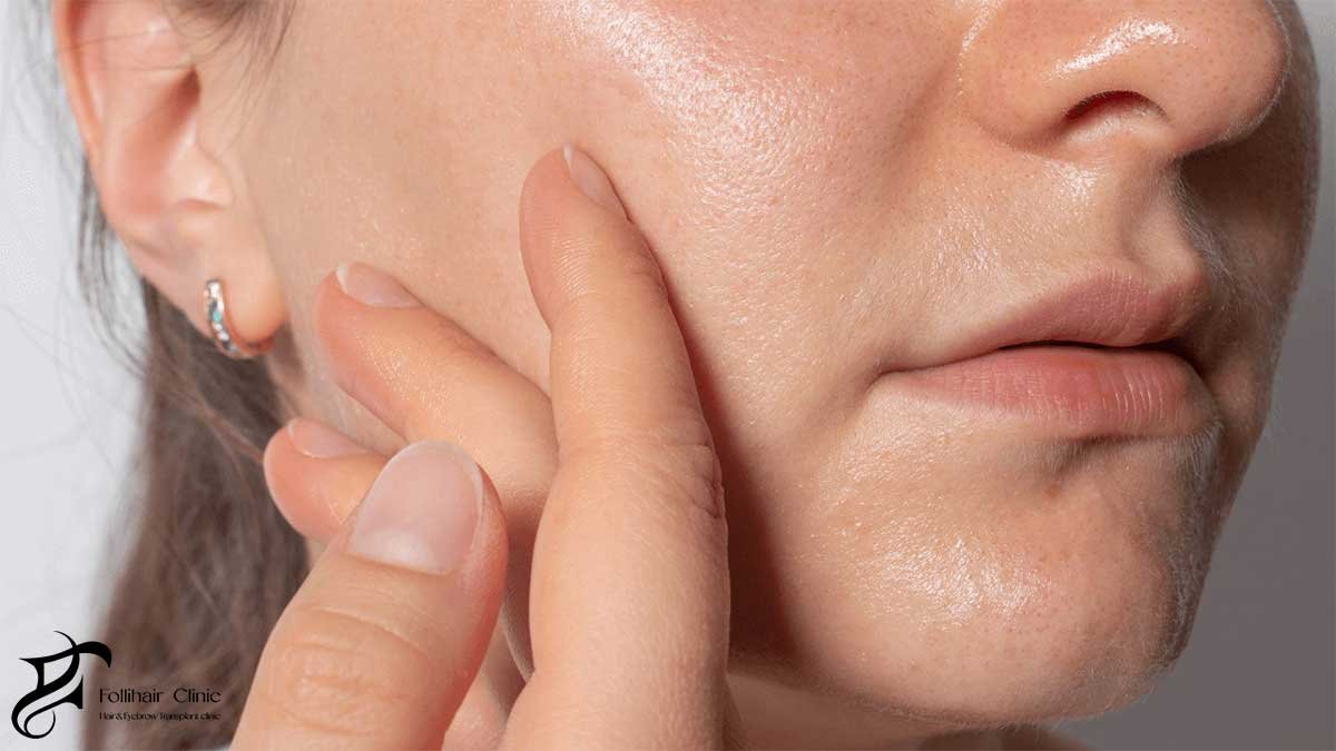 diet and lifestyle impact on oily skin