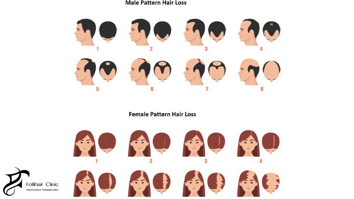 Female and male Pattern Hair Loss