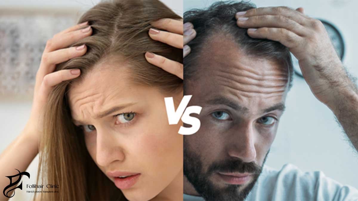 hair loss differences between men and women