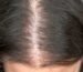hair thinning causes