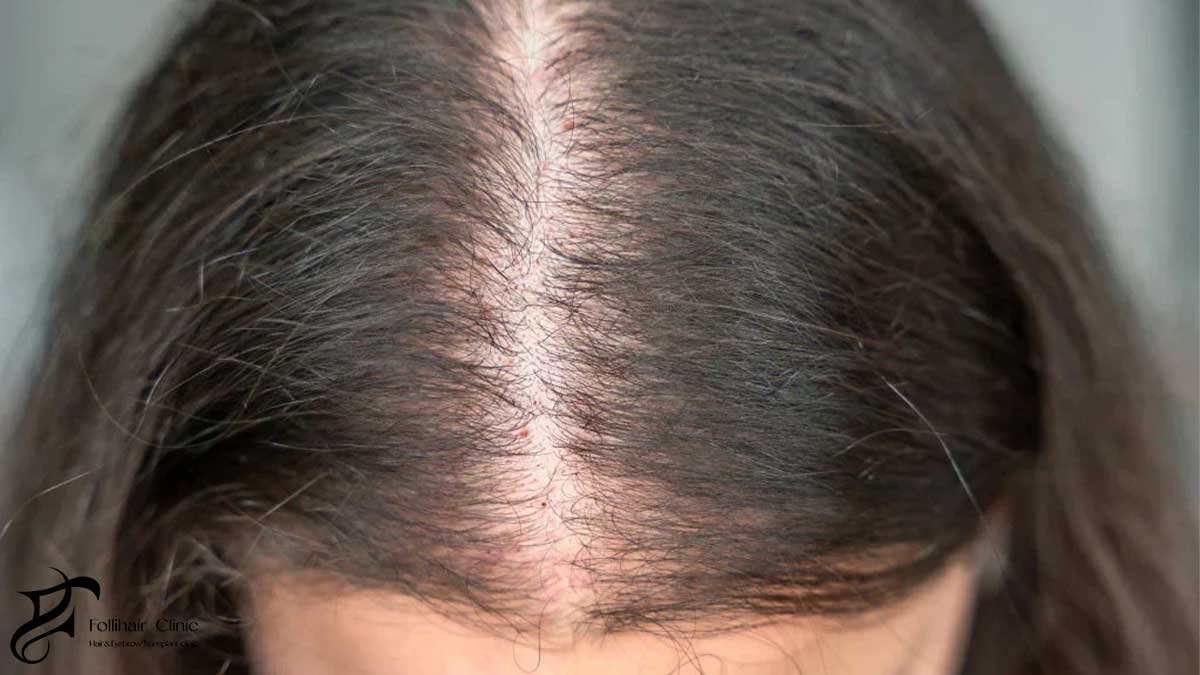 hair thinning causes
