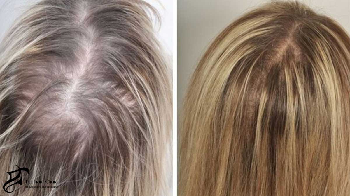 Stress-Related Hair Cycle Changes